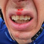 Jan Hirt se rompe los dientes después de que los fanáticos invadieran el paddock del equipo en el Tour de Francia